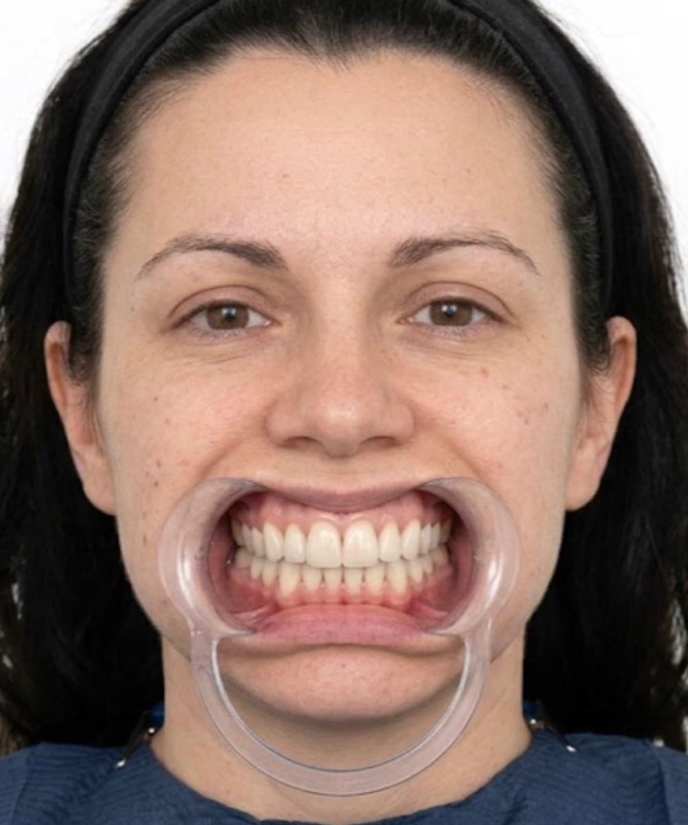 Veneers, after